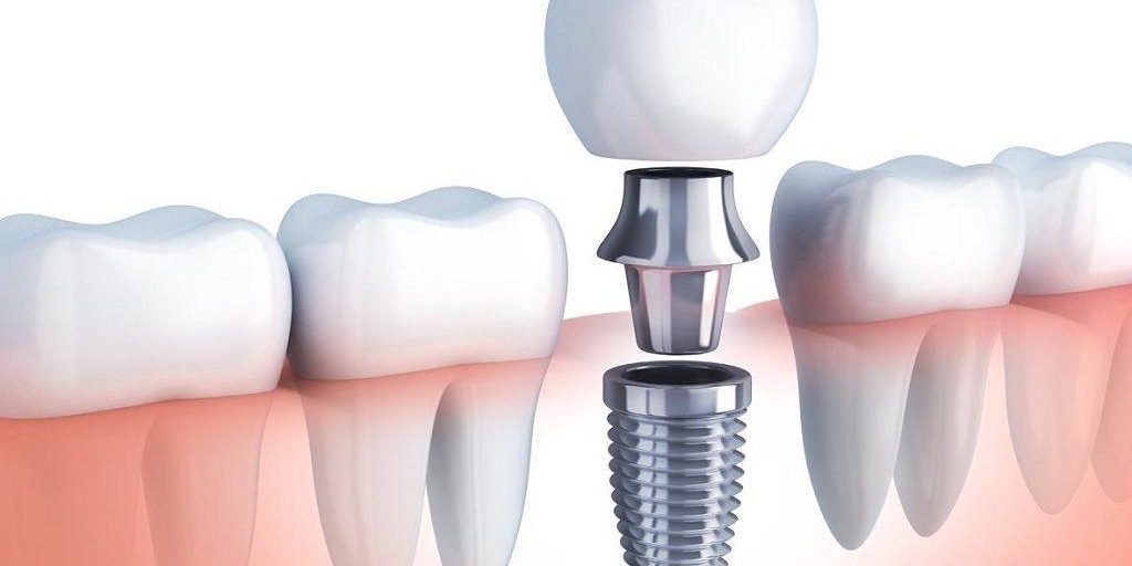 Qué son los implantes dentales Qué son los implantes dentales
