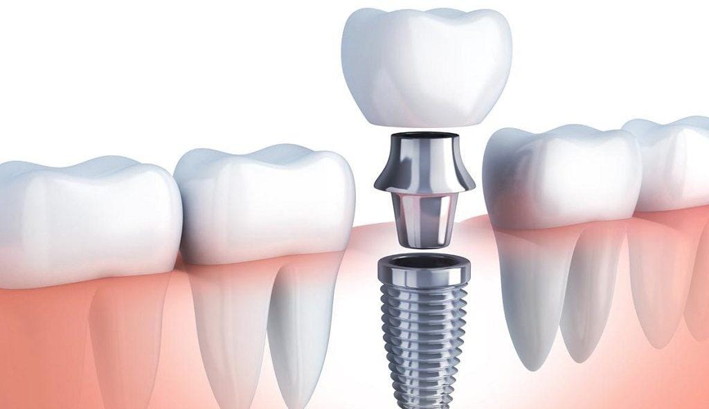 Qué son los implantes dentales