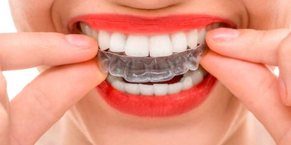 Ventajas de Invisalign