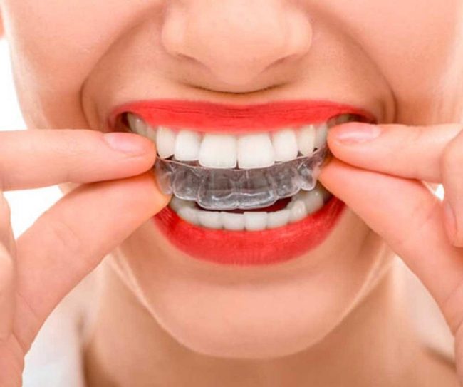 Ventajas de Invisalign