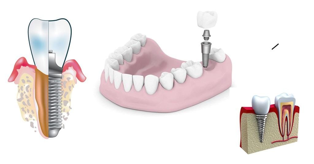 Qué son implantes one day treatment