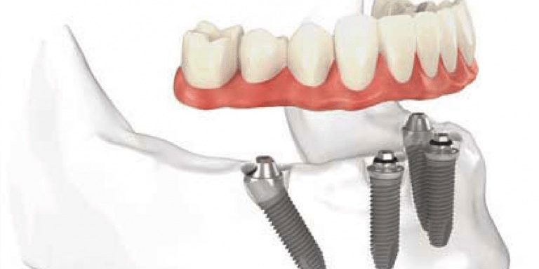 implantes-carga-inmediata-all-on-4-barcelona