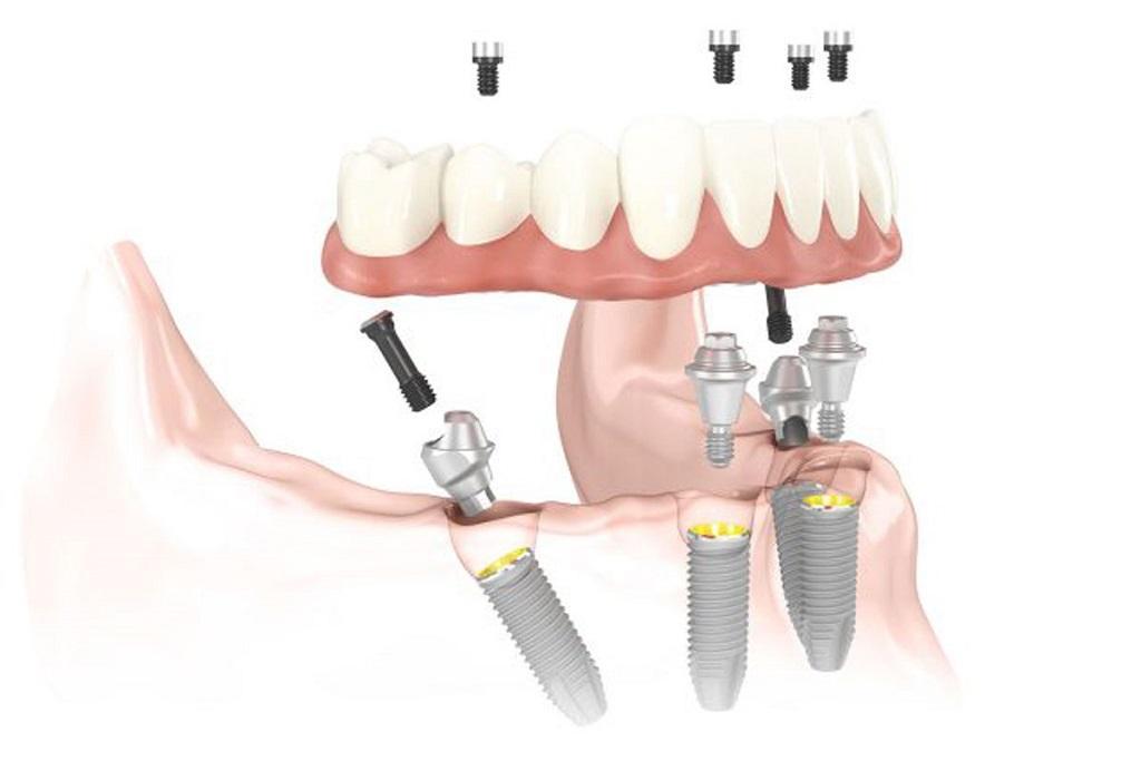 Implantes dentales con la técnica All-on-four