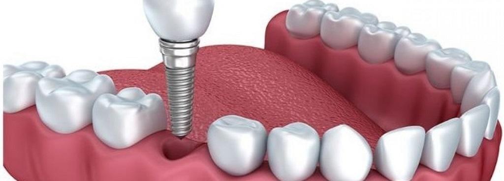 Preguntas frencuentes implantes dentales