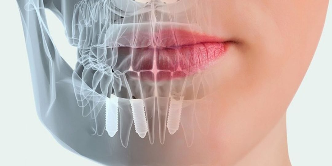 cirugia-guiada-por-ordenador-implantes-dentales-barcelona cirugia-guiada-por-ordenador-implantes-dentales-barcelona