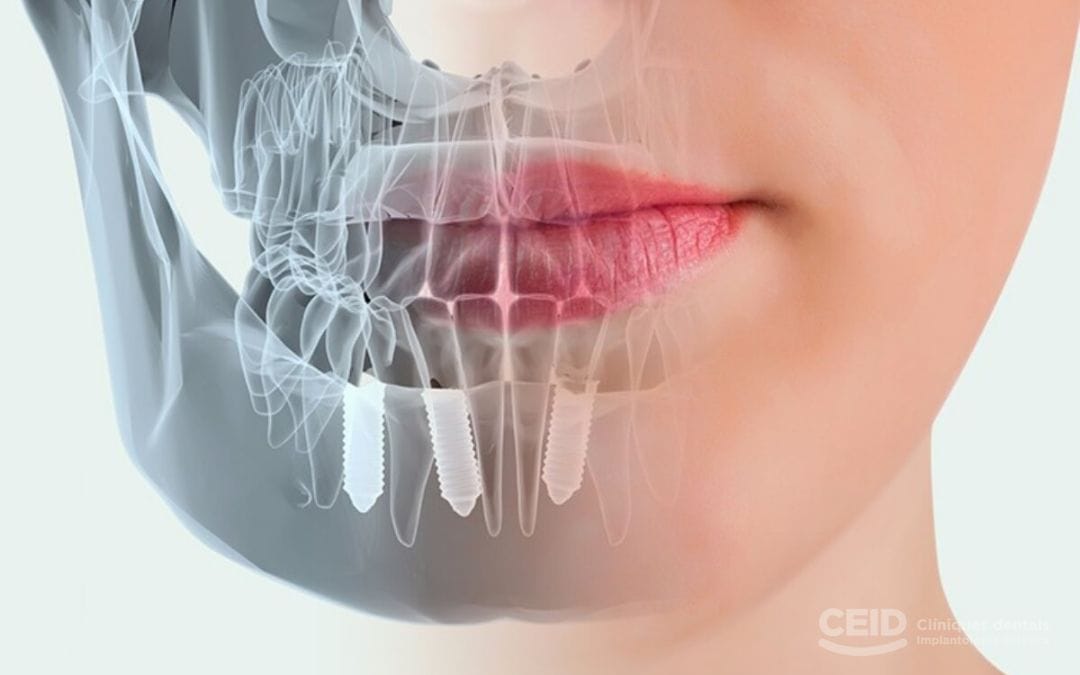 cirugia-guiada-por-ordenador-implantes-dentales-barcelona