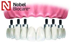 dentadura completa en una sesion Barcelona nobel biocare