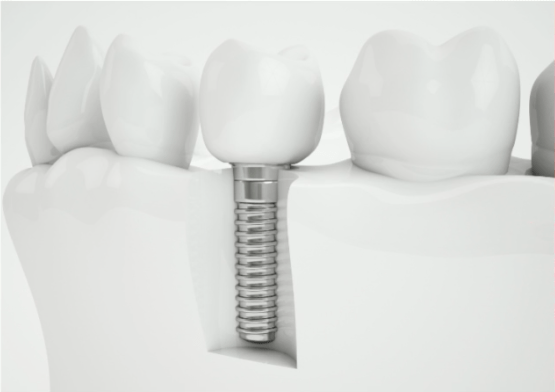 implantes dentales a precios económicos