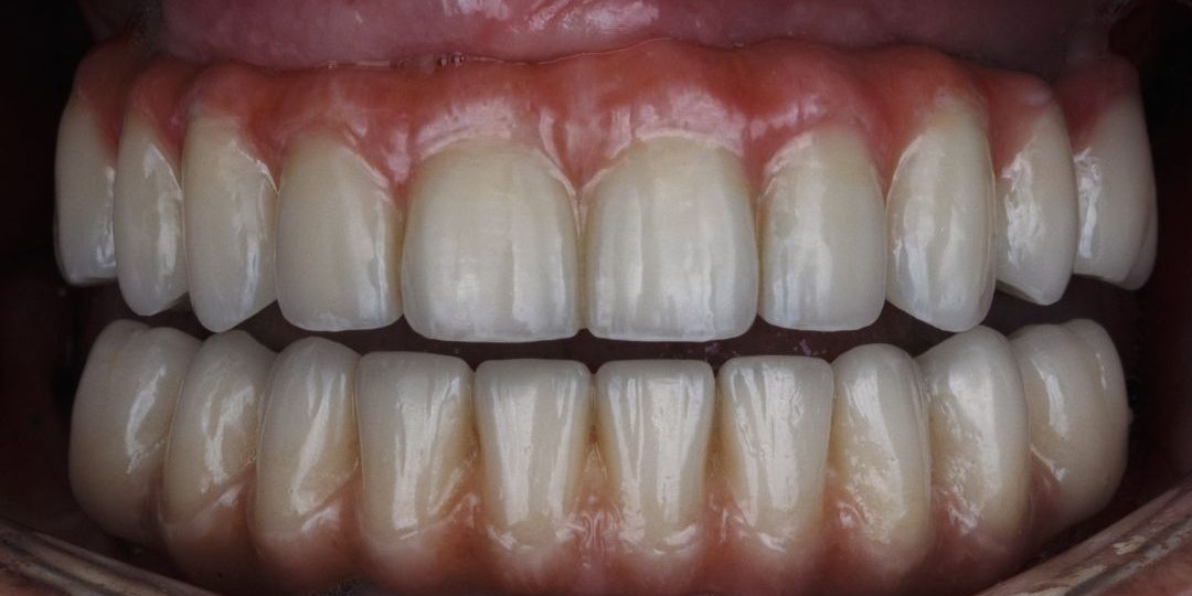 sobredentadura-sobre-implantes-en-barcelona