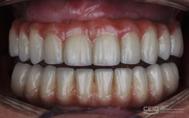 sobredentadura-sobre-implantes-en-barcelona