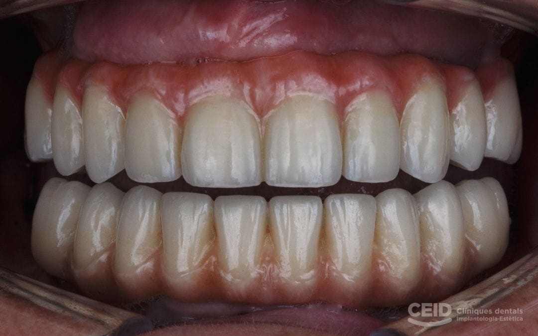 sobredentadura-sobre-implantes-en-barcelona