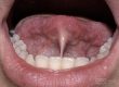 frenillo-orofacial-solucio-barcelona