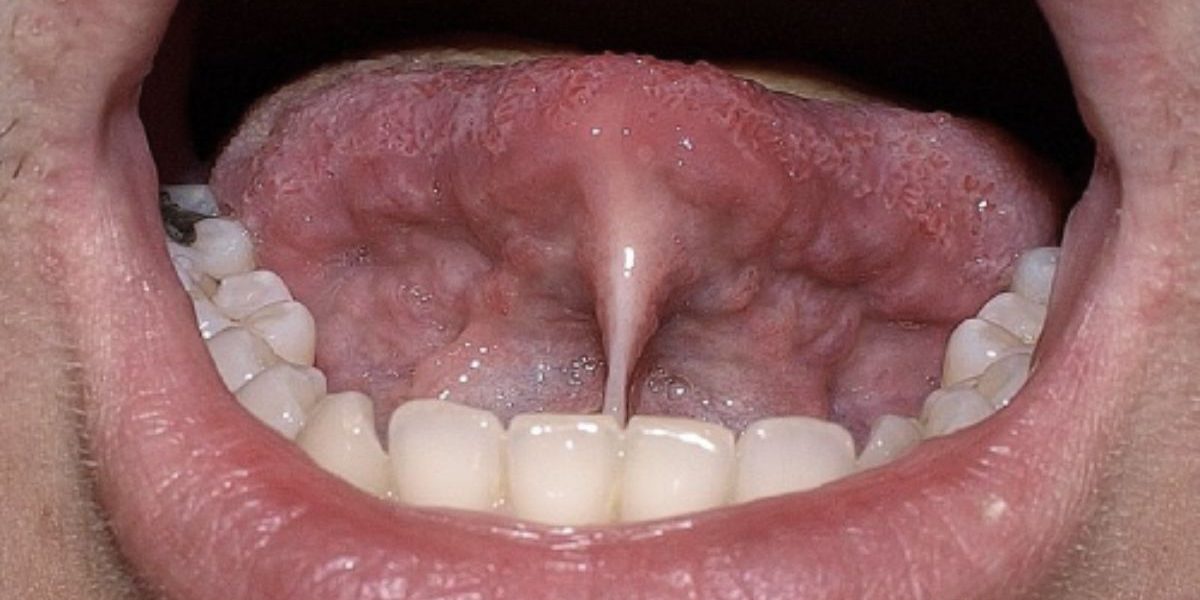 frenillo-orofacial-solucio-barcelona frenillo-orofacial-solucio-barcelona