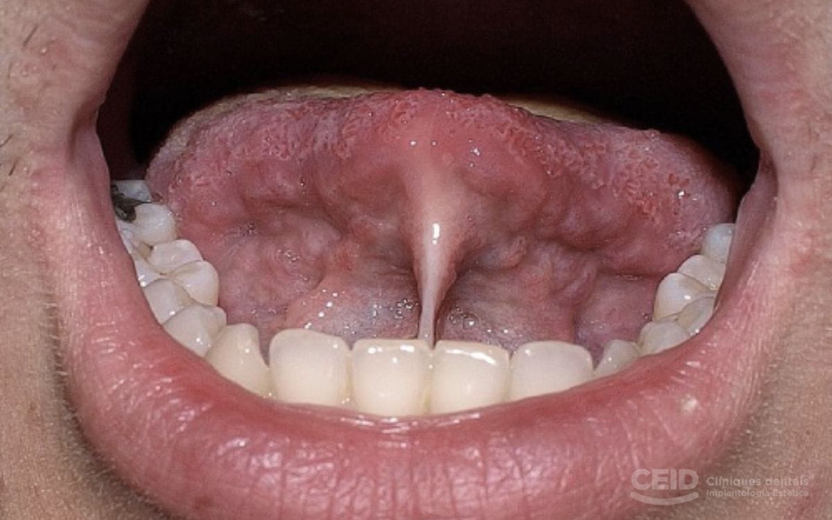 frenillo-orofacial-solucio-barcelona