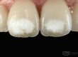 hipoplasia-dental-barcelona-esmalte-dental
