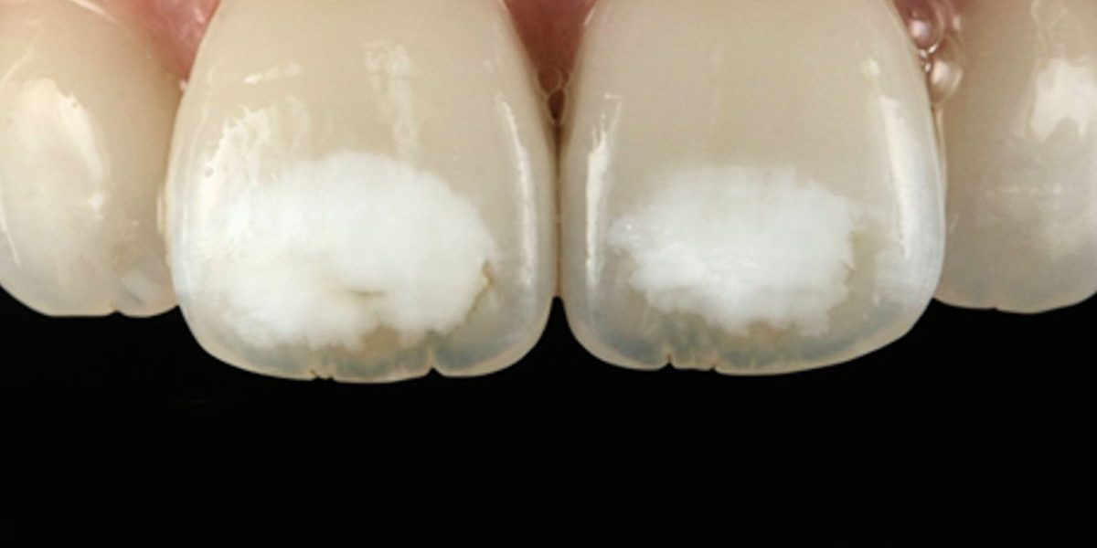 hipoplasia-dental-barcelona-esmalte-dental