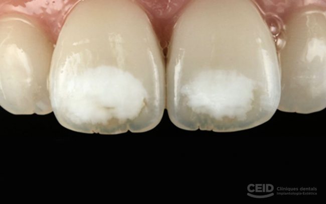 hipoplasia-dental-barcelona-esmalte-dental