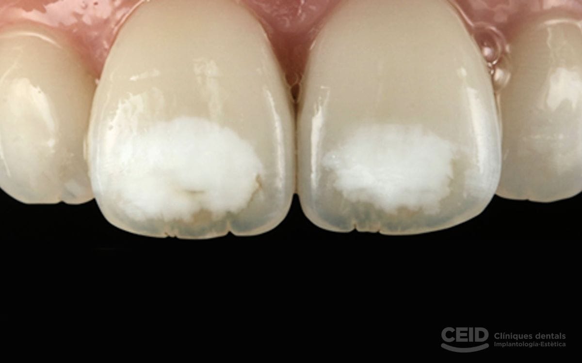 hipoplasia-dental-barcelona-esmalte-dental