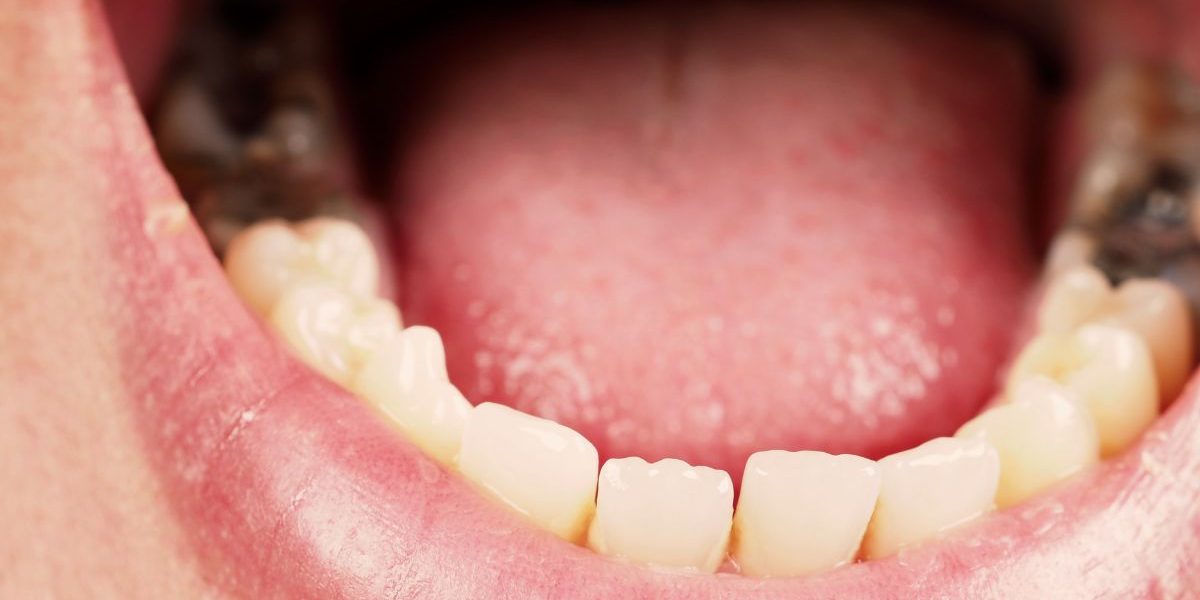 Muelas picadas – Entendiendo y abordando la caries dental