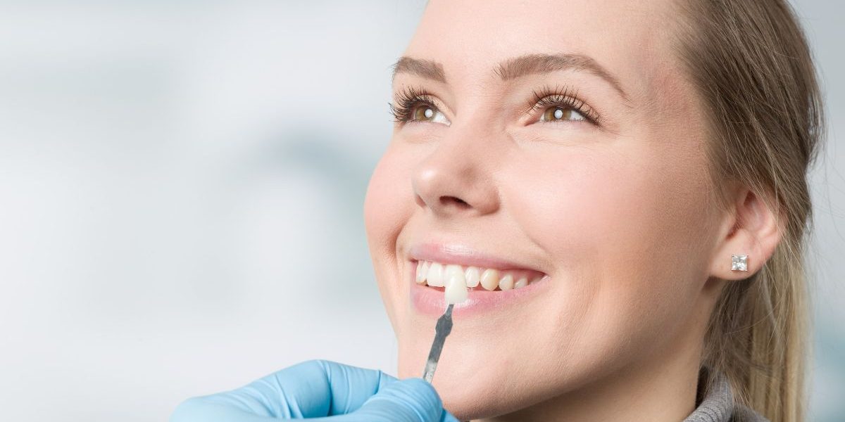 carillas-de-composite-barcelona carillas-de-composite-barcelona