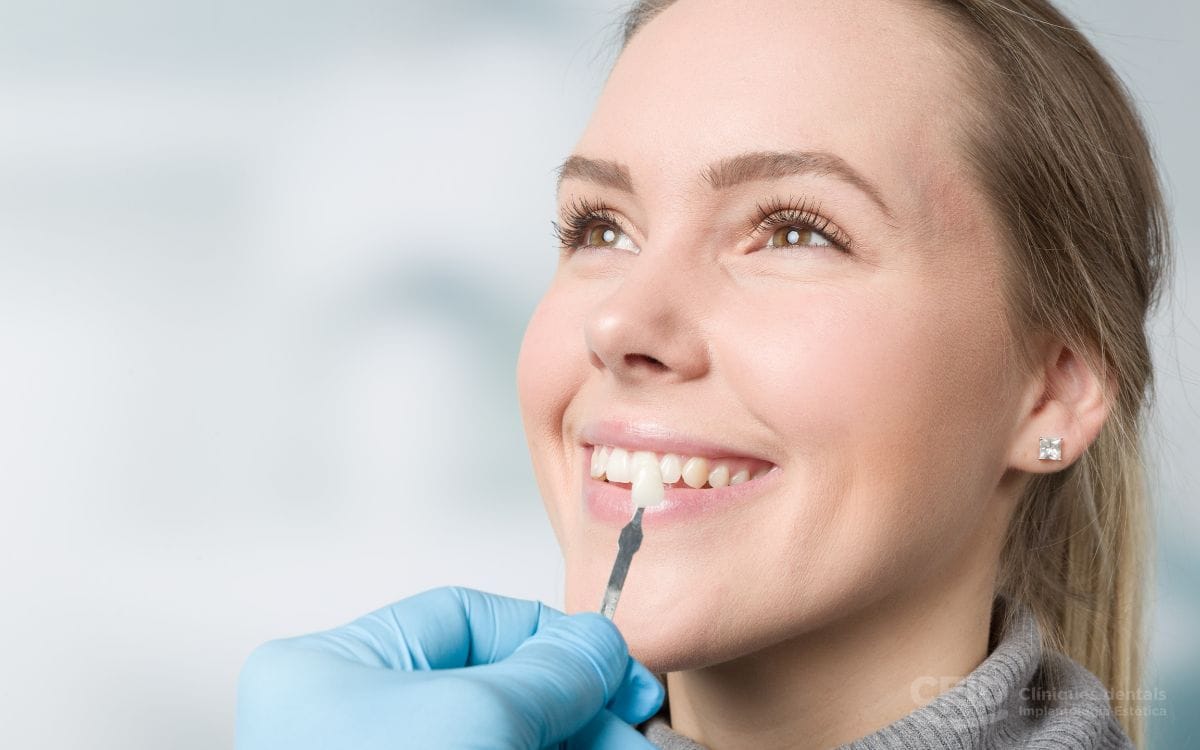 carillas-de-composite-barcelona