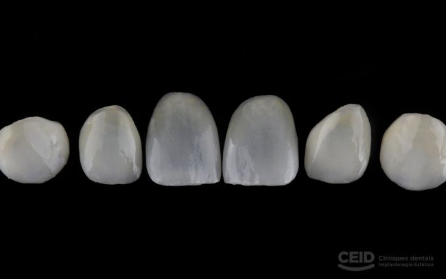 carillas-dentales-sin-tallado-barcelona