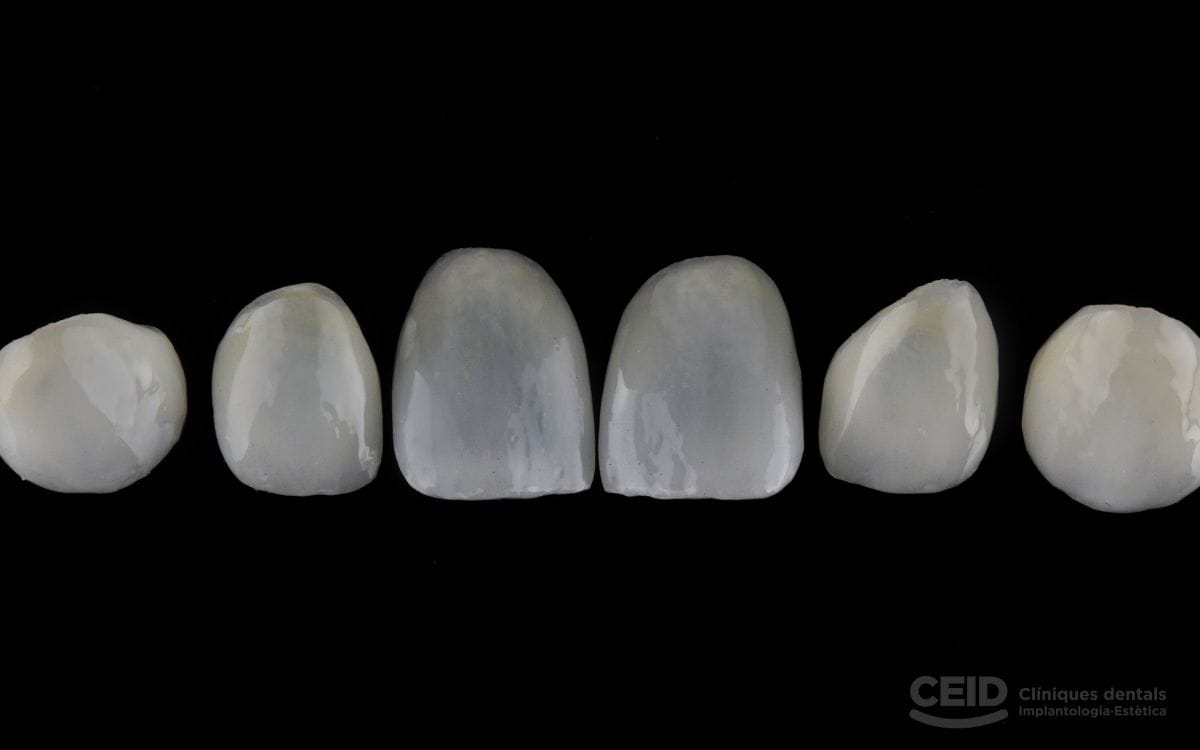 carillas-dentales-sin-tallado-barcelona