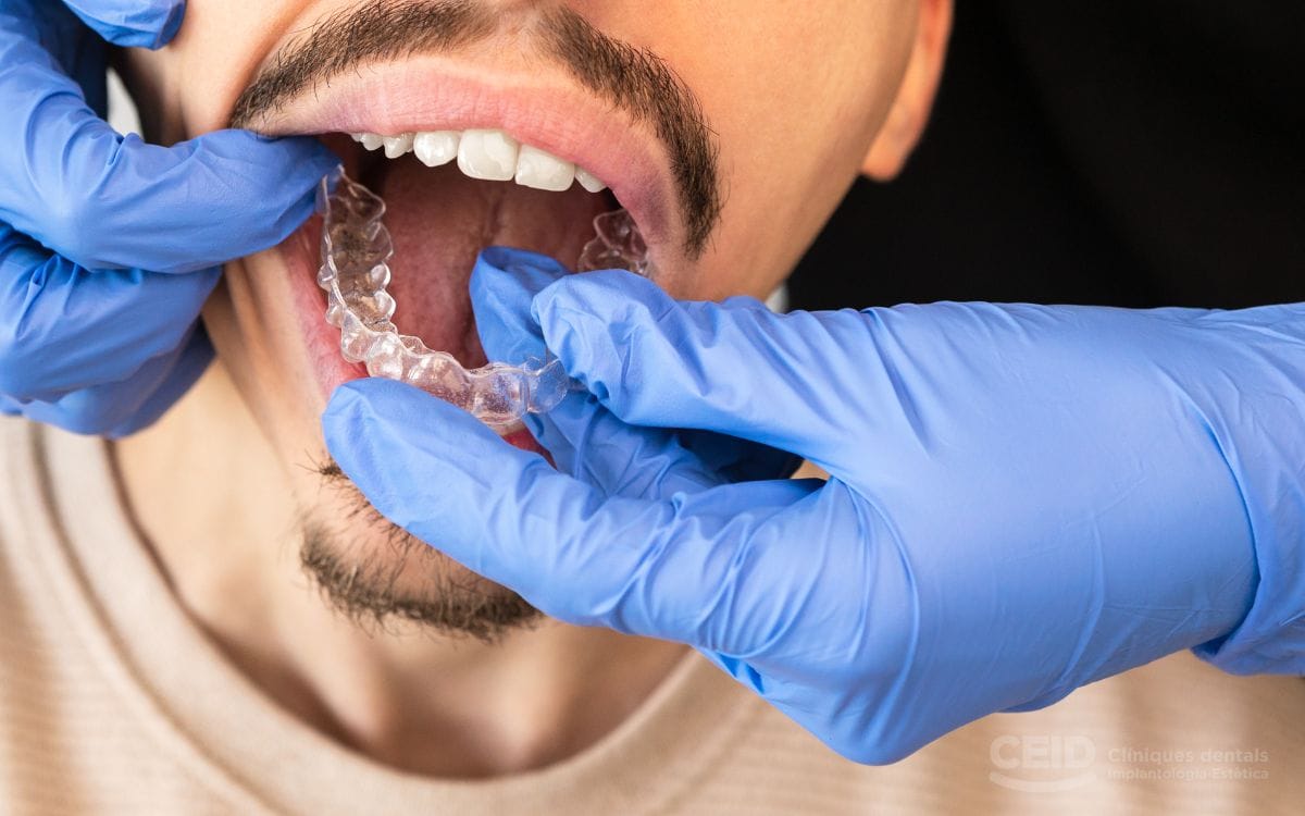 tratamiento-mordida-cruzda-con-ortodoncia-invisible-barcelona