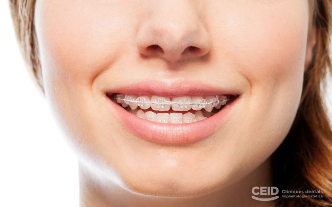 ortodoncia-estetica-barcelona-CEID