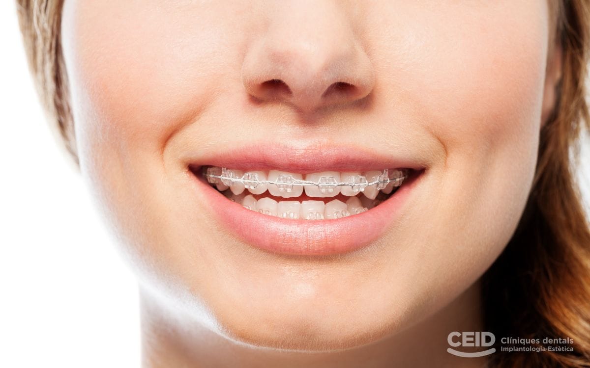 ortodoncia-estetica-barcelona-CEID