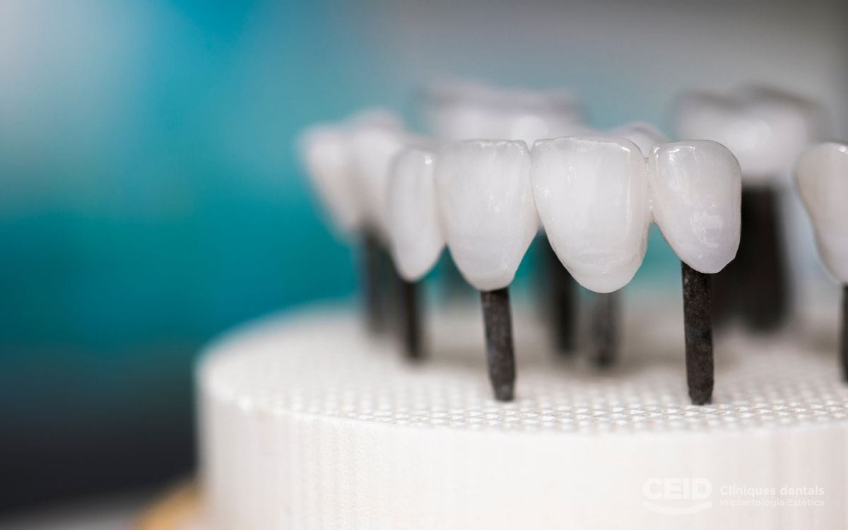 protesis-sobre-implantes-tipos-barcelona