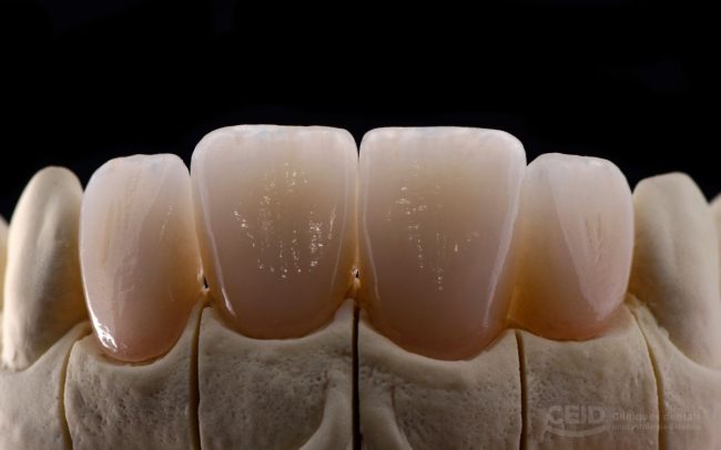 mejor-tratamiento-carillas-dentales-barcelona mejor-tratamiento-carillas-dentales-barcelona