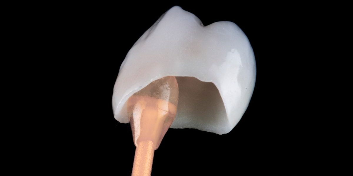 tipos-de-coronas-dentales-barcelona tipos-de-coronas-dentales-barcelona