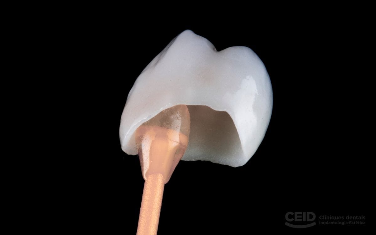 tipos-de-coronas-dentales-barcelona