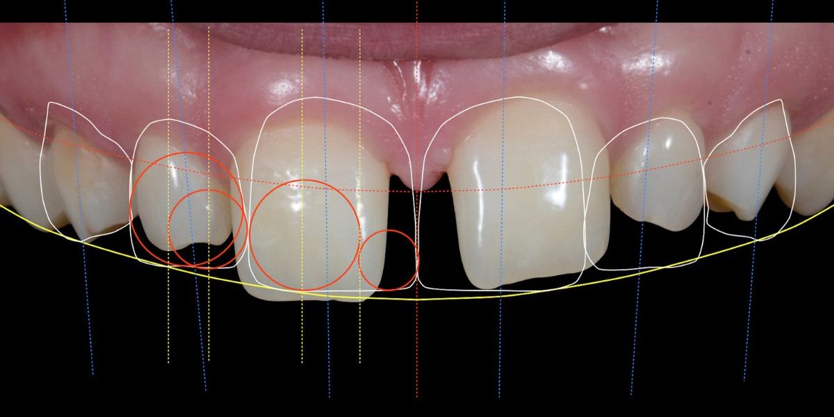 diseño-sonrisas-estetica-dental-barcelona-ceid-clinica-dental diseño-sonrisas-estetica-dental-barcelona-ceid-clinica-dental