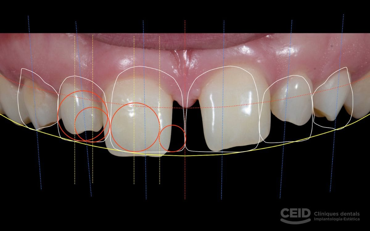 diseño-sonrisas-estetica-dental-barcelona-ceid-clinica-dental