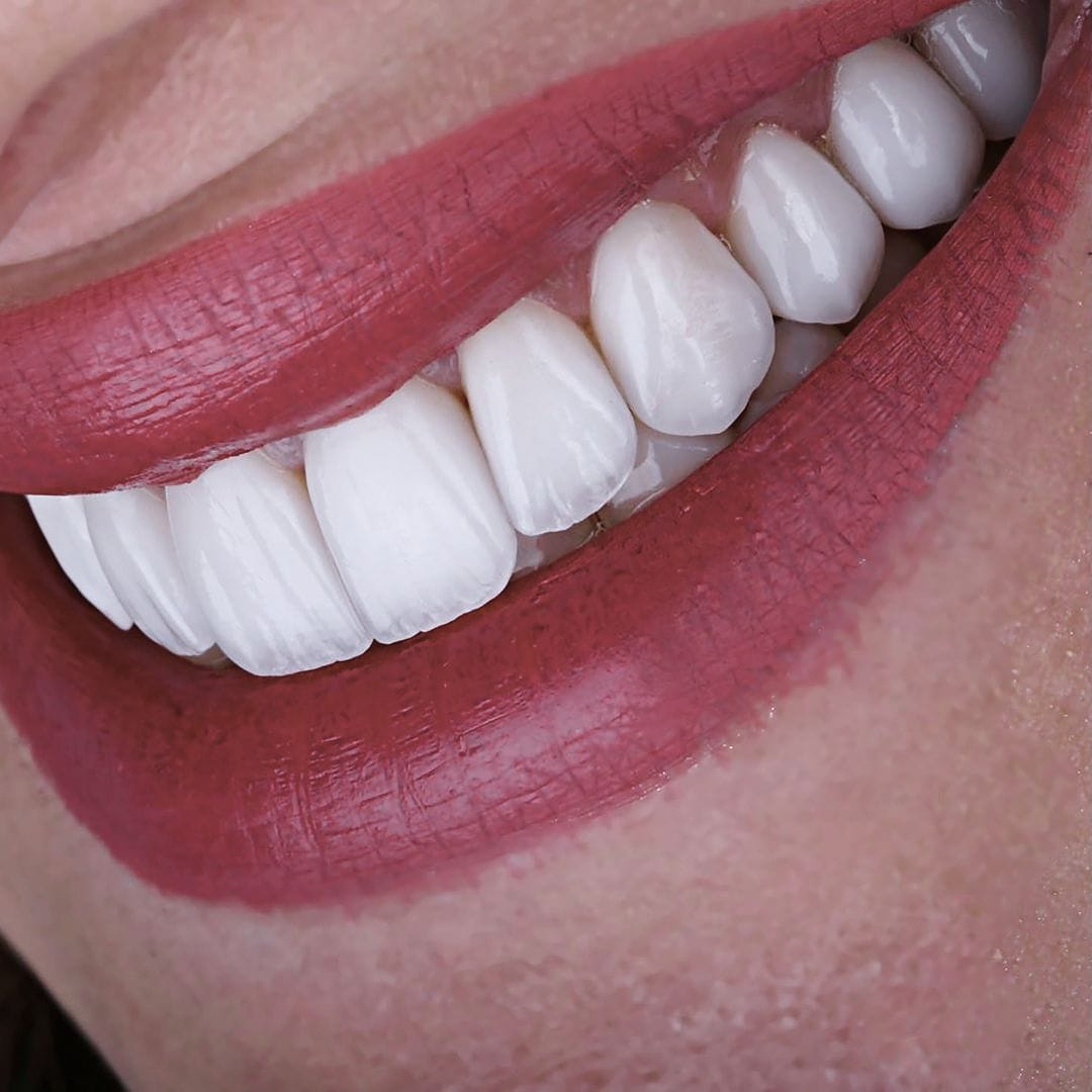 microcarillas-carillas-sin-tallado-barcelona-ceid