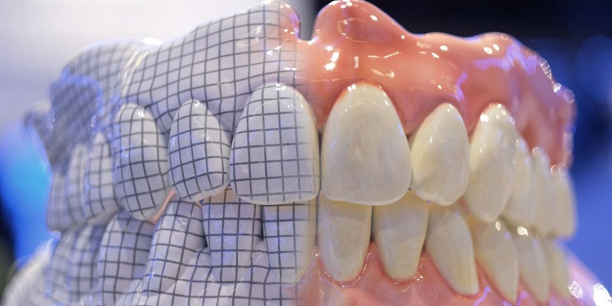 protesis-dentales-removibles-barcelona-CEID