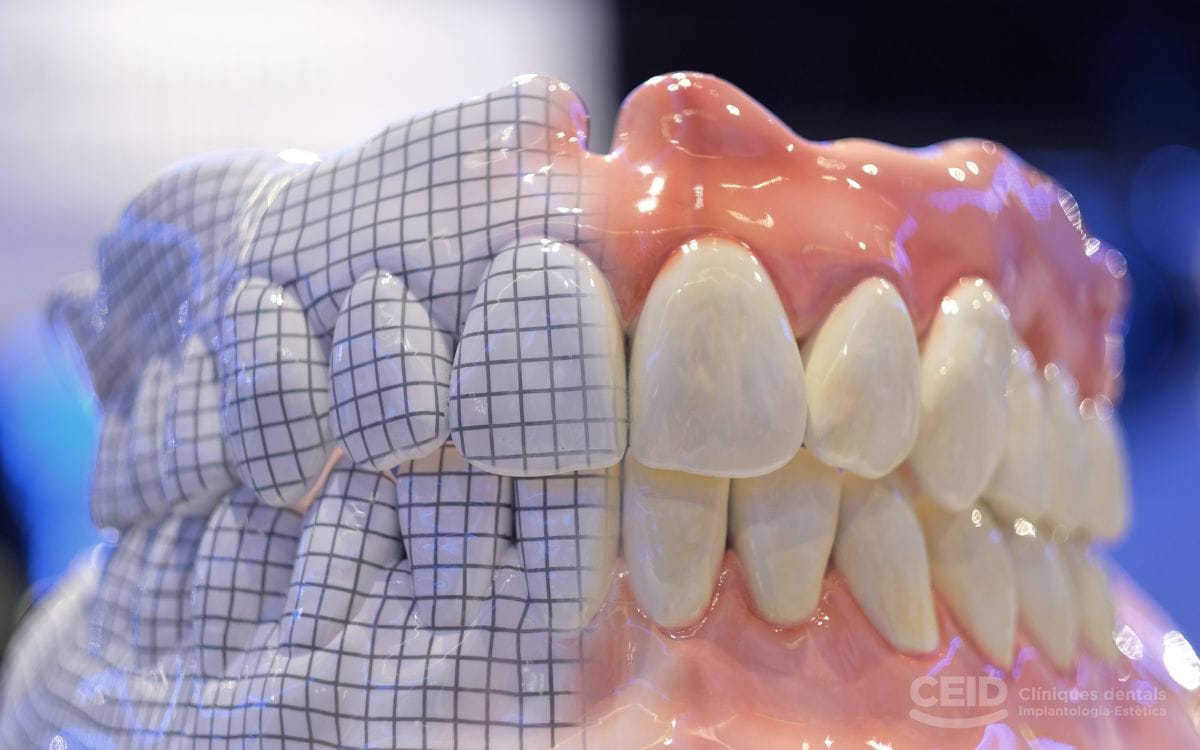 protesis-dentales-removibles-barcelona-CEID