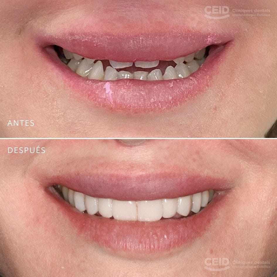 Paciente de CEID antes y después de carillas dentales