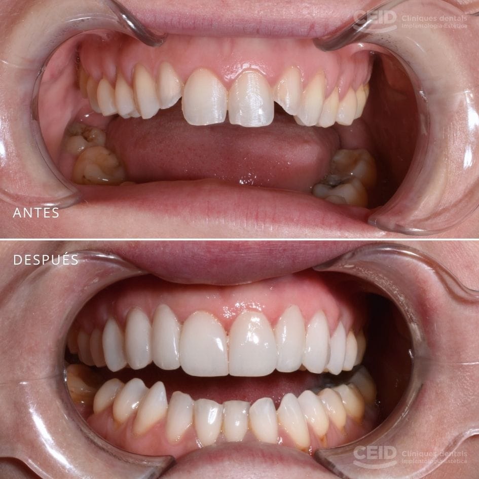 Boca antes y después de colocar carillas dentales en Barcelona