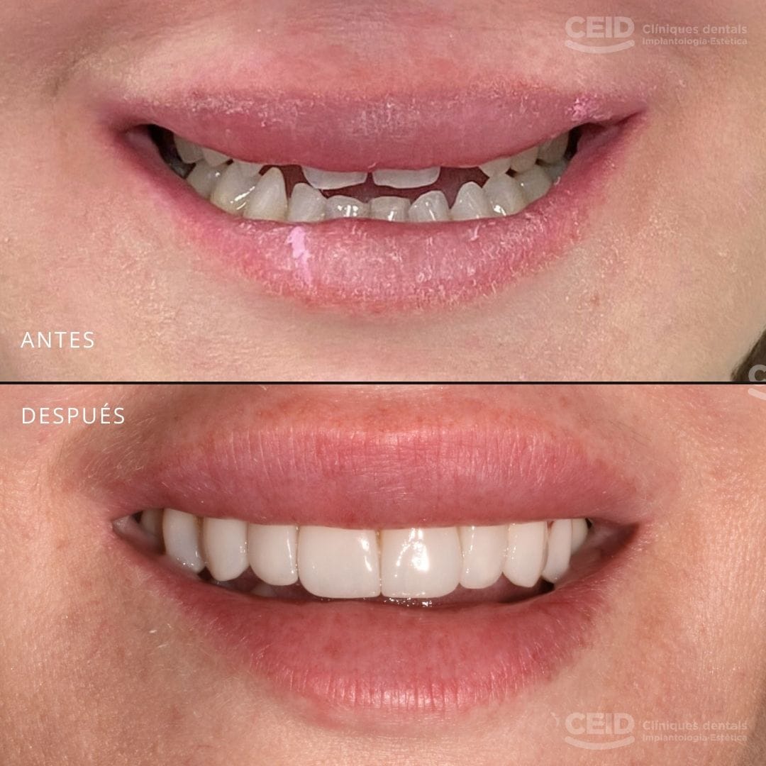caso-antes-despues-carillas-dentales-bartcelona-ceid-2