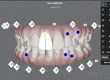 clincheck-invisalign-barcelona-eixample