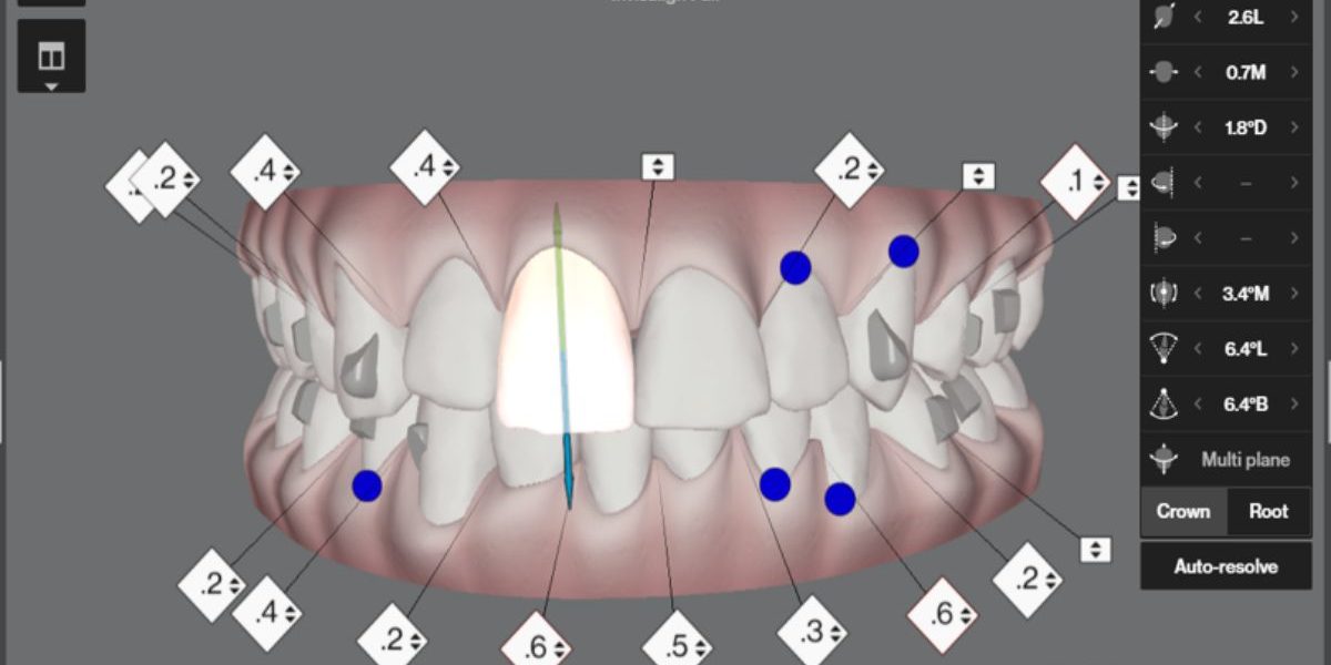 clincheck-invisalign-barcelona-eixample