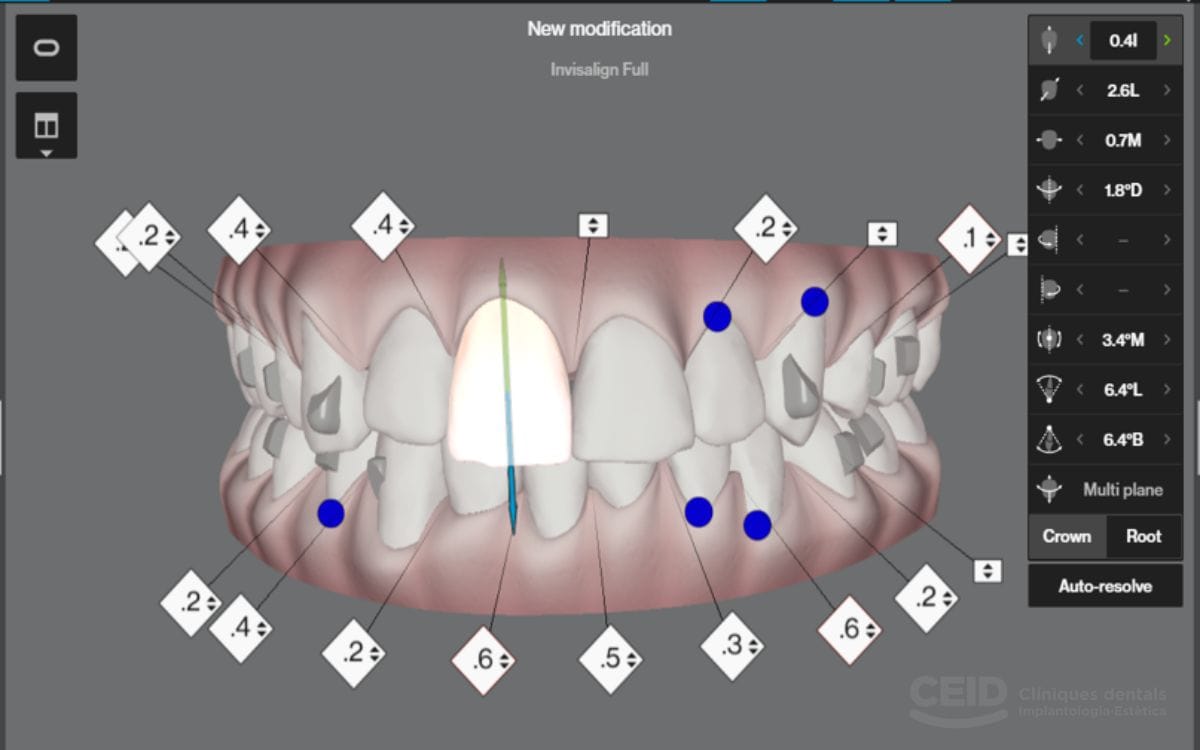 clincheck-invisalign-barcelona-eixample