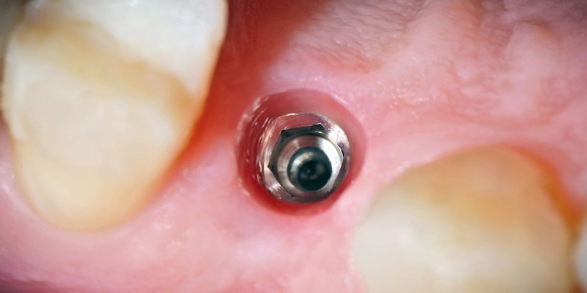 implantes-dentales-sin-hueso-barcelona