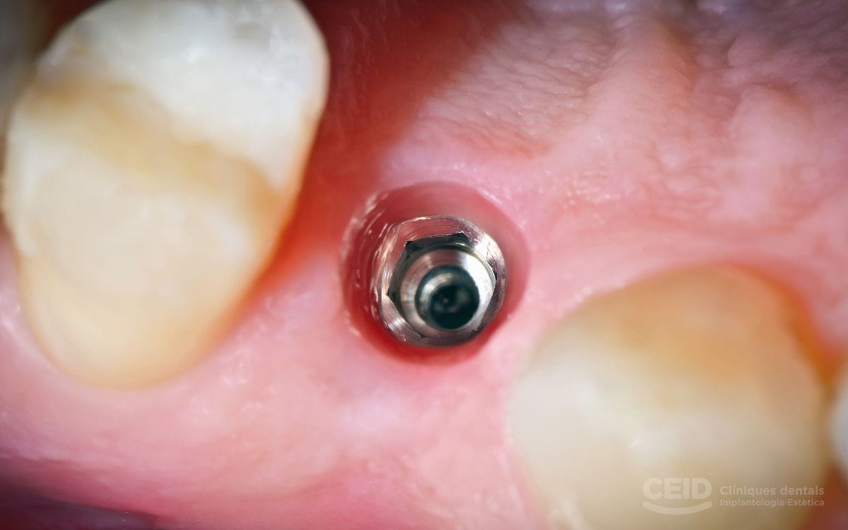 implantes-dentales-sin-hueso-barcelona