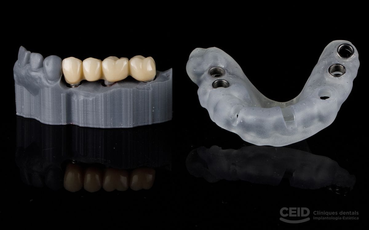 puentes-dentales-barcelona-CEID