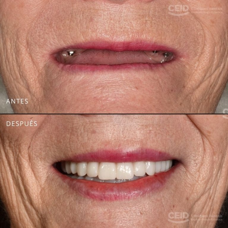 Sonrisa sin implantes y sonrisa con implantes dentales después de un tratamiento en CEID Barcelona