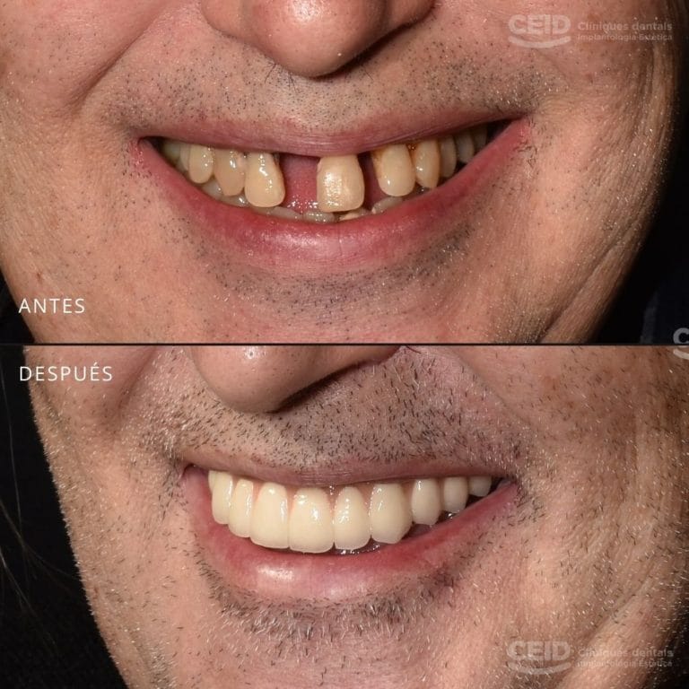 Antes y después del tratamiento de implantes dentales con carga inmediata en Barcelona